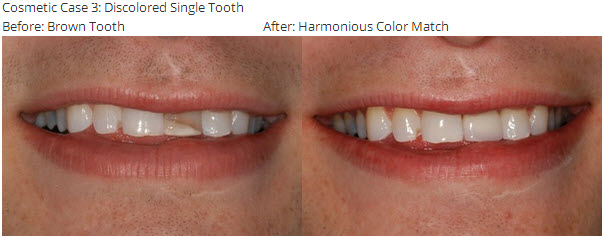 Cosmetic Case 3: Discolored Single Tooth