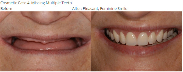 Cosmetic Case 4: Missing Multiple Teeth