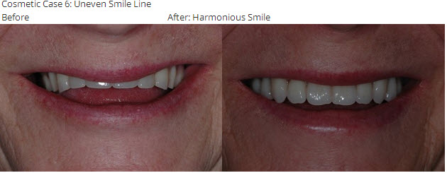  Cosmetic Case 6: Uneven Smile Line