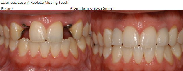  Cosmetic Case 7: Replace Missing Teeth